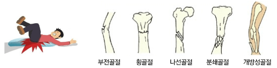 부전골절,횡골절,나선골절,분쇄골절,개방성골절